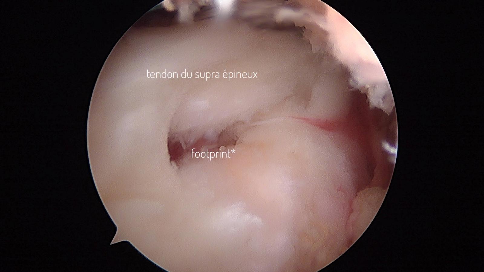 Vue per-opératoire d'une rupture du tendon supra-épineux - extra-articulaire