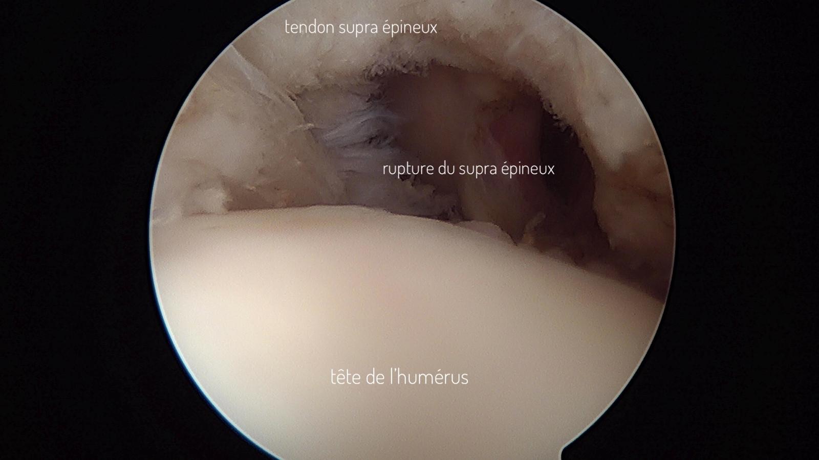 Vue per-opératoire d'une rupture du tendon supra-épineux - intra-articulaire
