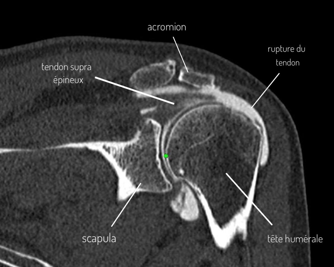 Arthro-CT montrant une rupture du tendon supra-épineux consécutive au conflit sous-acromial