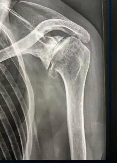 Radiographie d'une arthrose de l'épaule centrée