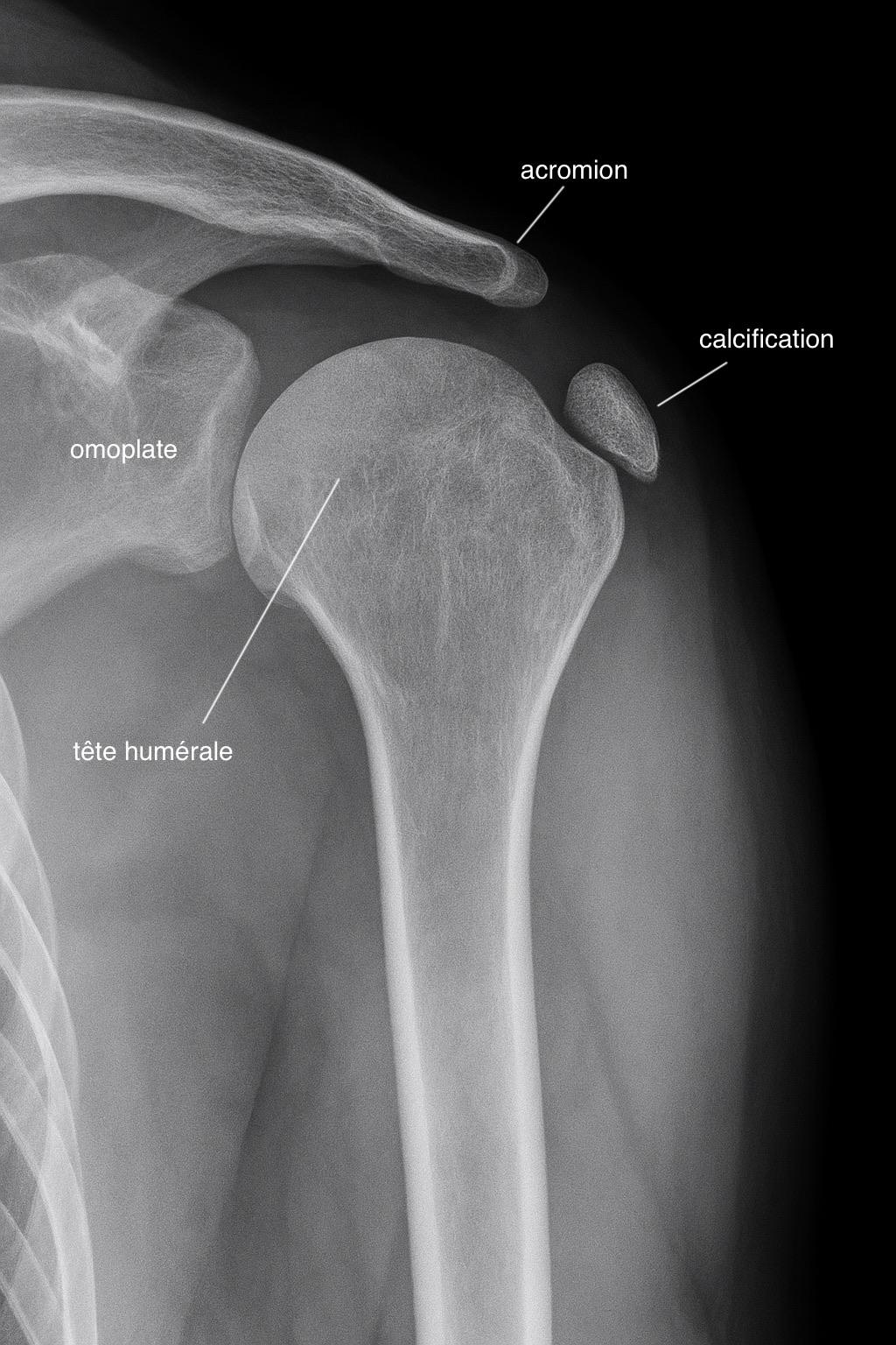 Radiographie montrant une calcification de l'épaule